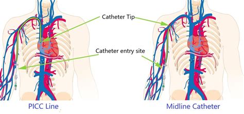 Picc Catheter