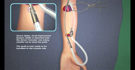 Dialysis Port In Arm surgical operation