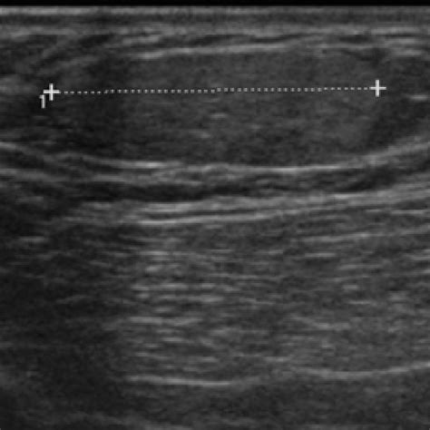 -Angiolipoma. Hyperechoic, oval, parallel mass, typical of lipoma/... | Download Scientific Diagram