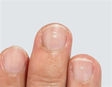 White spots on nails: Causes, prevention, and treatment