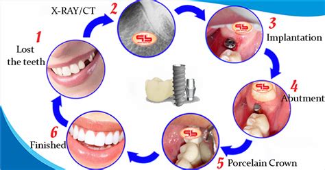 Dental Implant procedures according to international standards