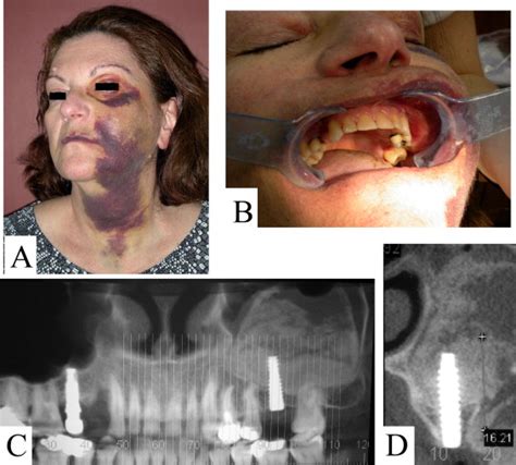 Complications of maxillary sinus augmentations in a selective series of ...