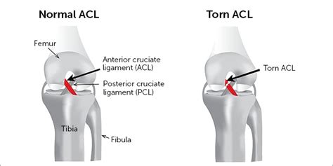 Anterior Cruciate Ligament [ACL] Tear - Sun Orthopaedic