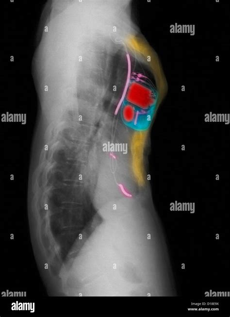 CXR of pacemaker, pectus excavatum chest deformity Stock Photo - Alamy