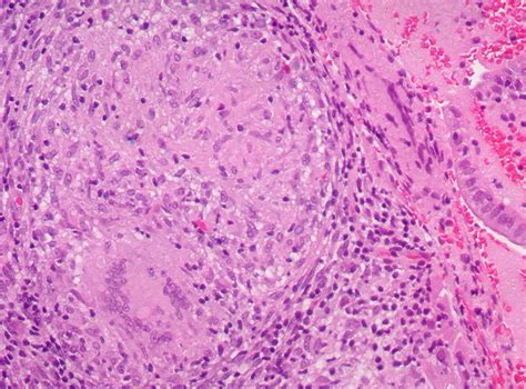 Pulmonary tuberculosis - Non-necrotizing granuloma | Flickr