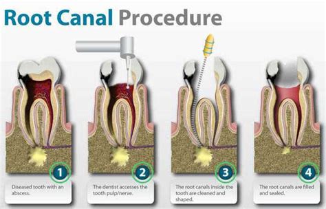 Overcome Tooth Pain thru Root Canal Treatment - emergency dental care los angeles