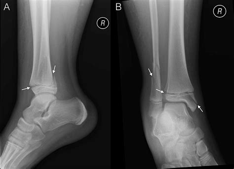 Atypical Triplane Fracture—Anteromedial Epiphyseal Sleeve Avulsion ...