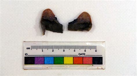 Adenomyomatosis - Surgical Pathology Photo Website