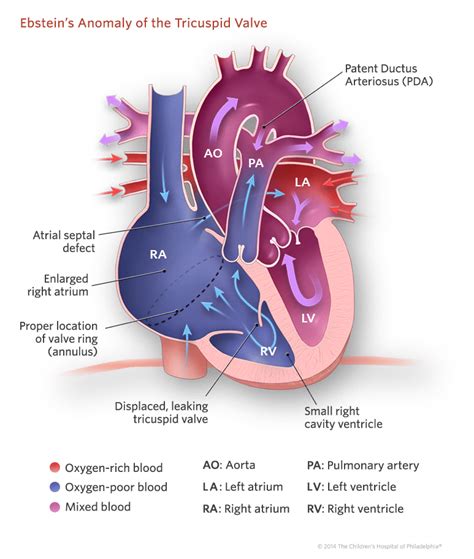 Ebstein’s Anomaly of the Tricuspid Valve | Children's Hospital of Philadelphia