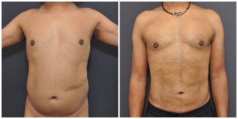 How Does Recovery After A Liposuction Look | Kaayakalp | Liposuction