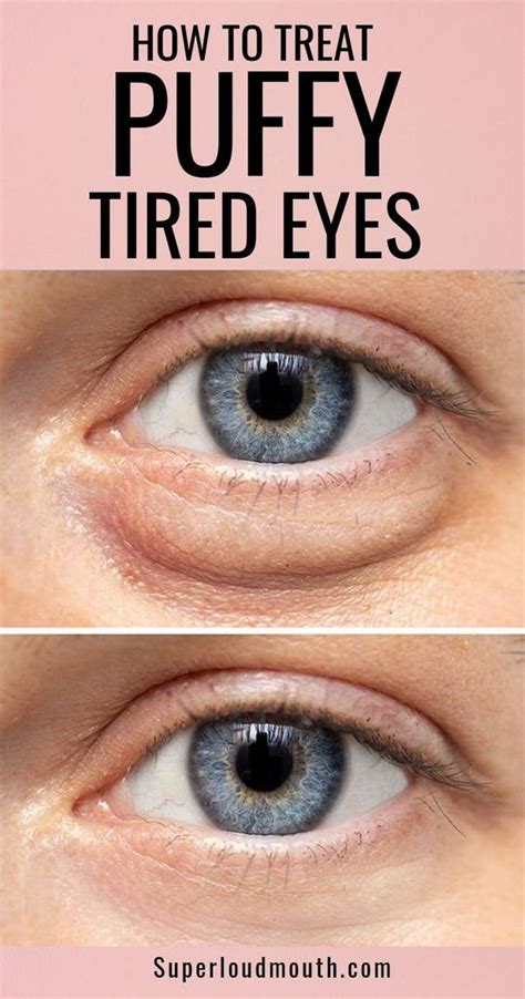 What your Eye bags tell about your health? How to get rid of them? | Puffy eyes remedy, Get rid ...