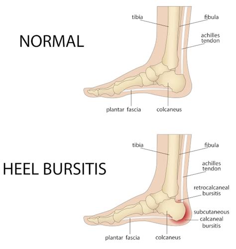 Foot Bursitis: What To Do with that Pesky Ball of Foot Pain