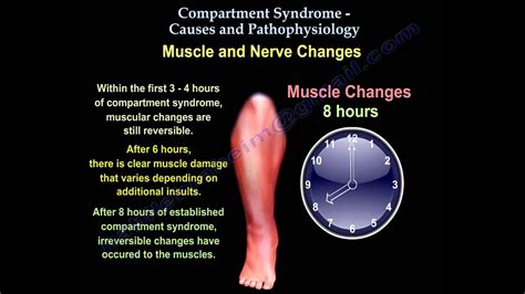 Compartment Syndrome Causes & Pathophysiology - Everything You Need To ...