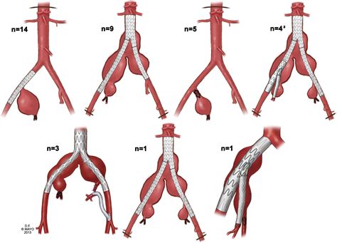 Outcomes of open and endovascular repair for ruptured and nonruptured ...