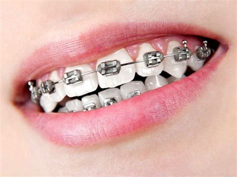 Silver Black Braces | Ligas para brackets, Brackets dentales