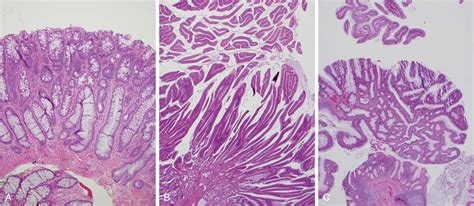 Colonic Polyps and Polyposis Syndromes - Clinical Tree