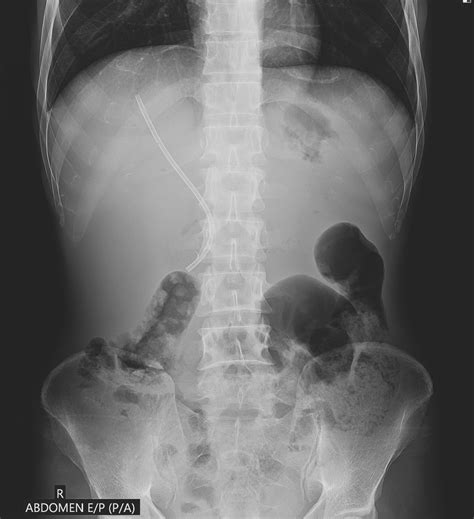 Ercp Stent