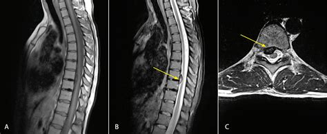 Herniated Disc Thoracic Mri