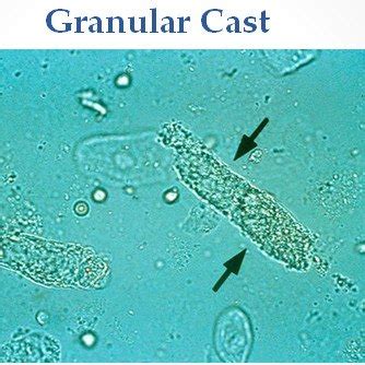 Granular Cast | Medical Laboratories