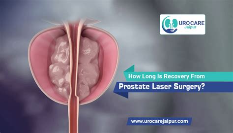 How Long Is Recovery from Prostate Laser Surgery?