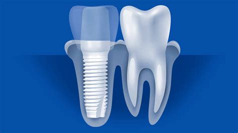 Ceramic Dental Implants In Beverly Hills, CA