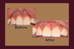 Frenectomy Chandler, AZ | Scholes Periodontics & Implants