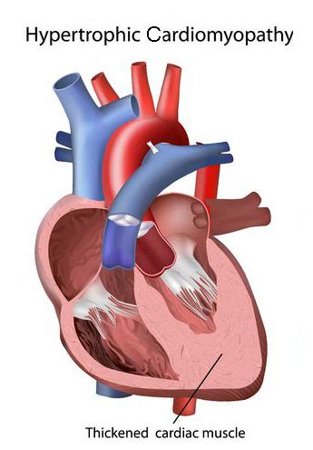 HOCM Hypertrophic Obstructive Cardiomyopathy - Cardiology - Highland ...