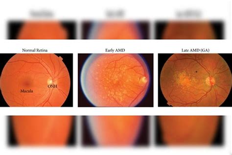 Macular Degeneration Cure – Everything You Possibly Need To Know ...