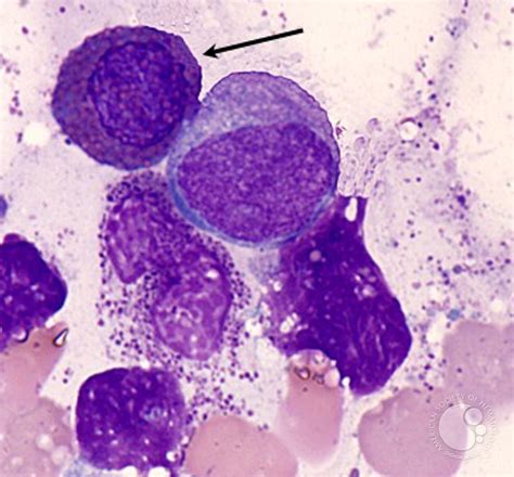 Eosinophilic myelocyte - 1.