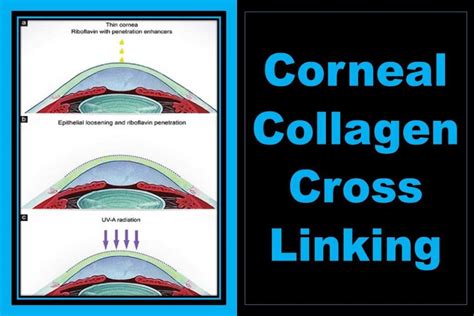 Corneal Collagen Cross-Linking: Procedure, Types, & Uses | Health Kura