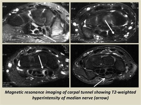 Carpal Tunnel Syndrome Mri