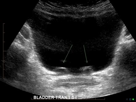 Ureterocele | Radiology Reference Article | Radiopaedia.org