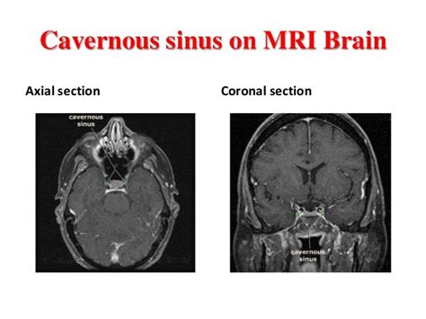 Cavernous sinus thrombosis.pdf ppt