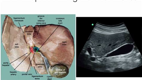 Intro to hepatobiliary ultrasound - YouTube