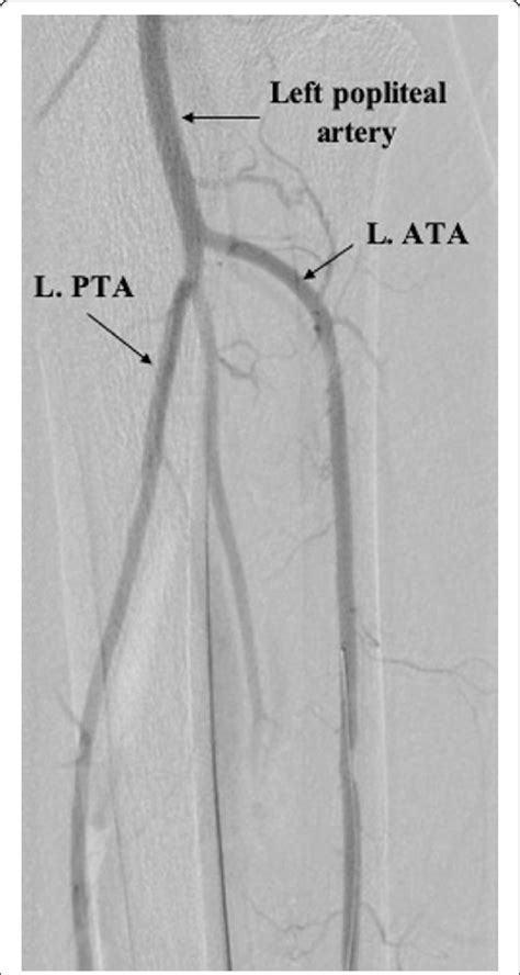 Posteriortibialarteryangiogram