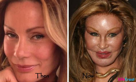 7 Celebrity Plastic Surgeries Gone Wrong | LifeCrust