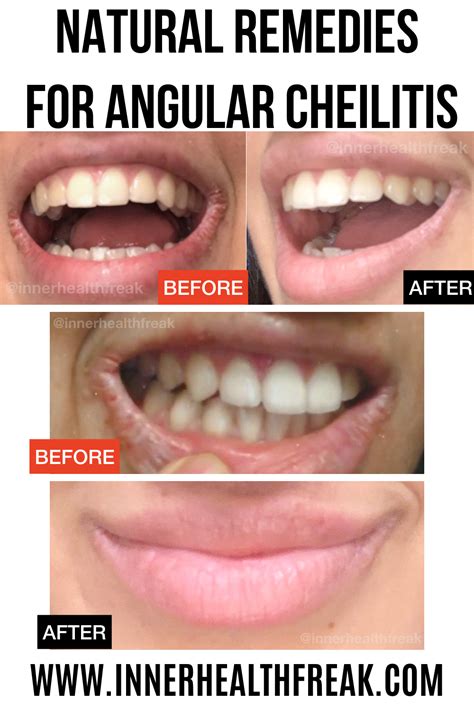 Angular Cheilitis Natural Treatment - Pregnant Center Informations