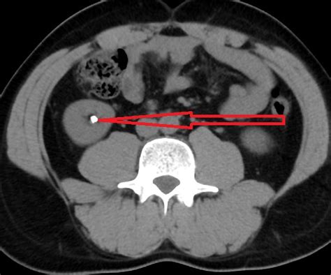 Diagnosis of Kidney Stones and Ureteral Stones - NYC Kidney Stone Clinic