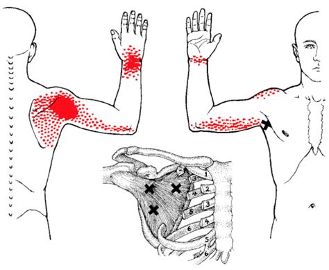 Trigger Point Therapy