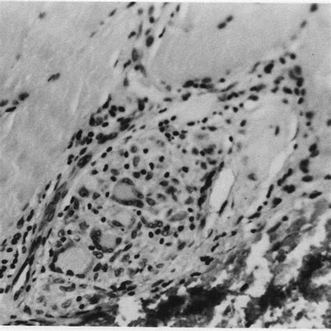 Angiolymphoid hyperplasia with eosinophilia. 1a – clinical close up of... | Download Scientific ...