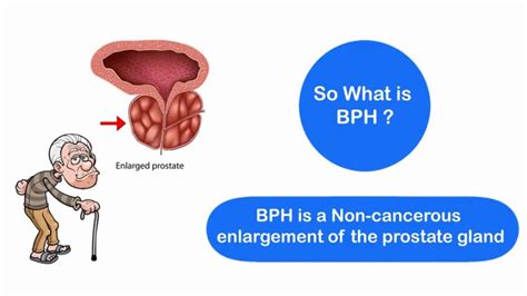 Benign Prostatic Hyperplasia Enlarged Prostate