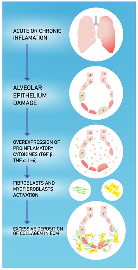 How To Prevent Pulmonary Fibrosis - Gameclass18