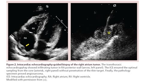 Intracardiac echocardiography for guiding biopsy of cardiac tumor