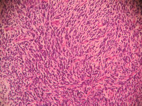 GLIOSARCOMA (ATLAS) – Histopathology.guru