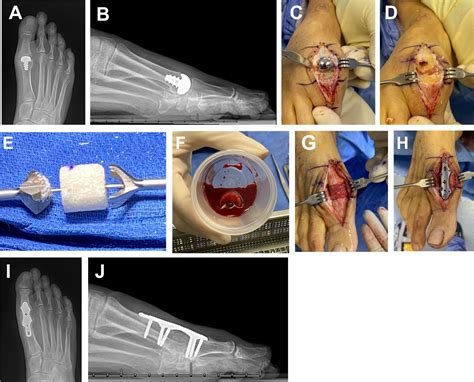 Complications of Hallux Rigidus Surgery - Foot and Ankle Clinics