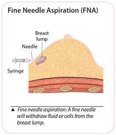 Breast Cancer - Risks, Symptoms & Treatments | SingHealth