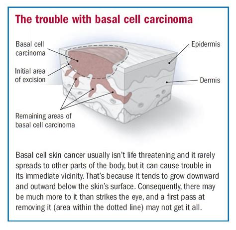 Basal Cell Skin Cancer Treatment