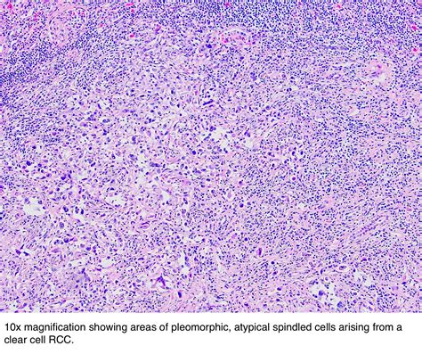 Pathology Outlines - Sarcomatoid renal cell carcinoma