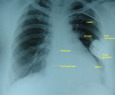 Dual chamber pacemaker – X-ray chest PA – All About Cardiovascular System and Disorders