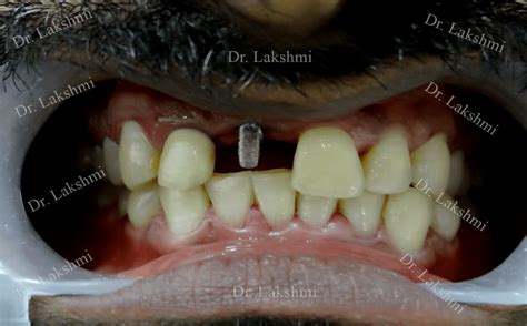 Dental Implants In Bangalore| Best Tooth Implant in Bangalore